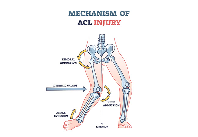 A Deep Dive into ACL Injuries