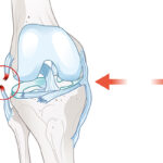 Inside ACL Injuries: Causes, Impact, and Recovery