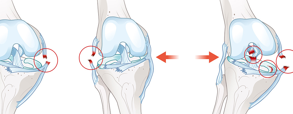 Inside ACL Injuries: Causes, Impact, and Recovery
